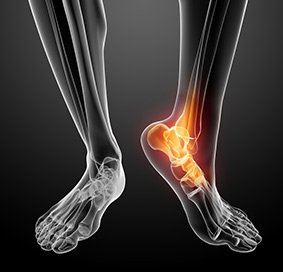 Stiff Big Toe (Hallux Rigidus)